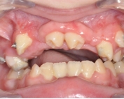 Frontal Intraoral Photo, O'Keeffe Orthodontics